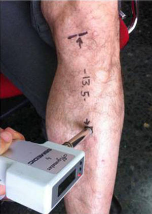 Use of the pressure algometer in the study point at 13.5cm of the joint interline.