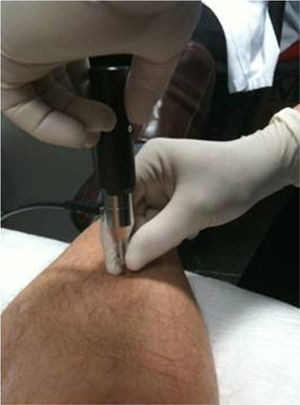 Microindentation technique applied at the level of the tibial diaphysis.