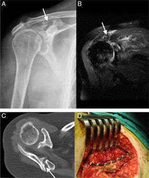(A) Simple radiograph in anteroposterior projection: fracture of the base of the acromion (arrow) and elevation of the humeral head. (B) Magnetic resonance imaging (MRI): massive rotator cuff tear (arrow). (C) Computed tomography (CT) scan showing a displaced fracture of the spine of the scapula, with no evidence of consolidation (arrow). (D) Internal fixation with a reconstruction plate.