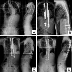 (A) Child aged 9.8 years with idiopathic scoliosis and pectus excavatum, with severe pulmonary restriction. He presented progressive right thoracic scoliosis of 64°, a T1–L1 length of 19cm and skeletal immaturity. (B) The patient was treated with bilateral growing rods with an initial coronal correction of 53%. The first elongation took place after 14 months and the second elongation after a further 8 months. (C) The control radiograph before the definitive fusion shows the progression of the curve and a distal adding-on phenomenon. (D) Two years after the definitive posterior fusion, with a final coronal correction of 75%, a final T1–L1 length of 25cm and resolved adding-on.