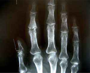 AP projection of PIP osteoarthritis in the index finger.