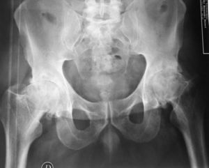 Advanced degenerative signs in both hips. Reduction of the joint space with subchondral cysts in both aspects of the joint. Deformity of both hips with osteophytes and bone excrescences. Evolution of bilateral hip osteonecrosis.