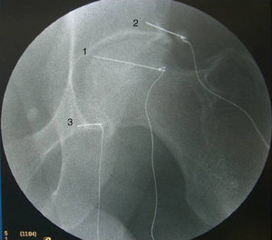 Radiographic control of hip block, with needles in an intraarticular position (1), sensory branch of the femoral nerve (2) and sensory branch of the obturator nerve (3).