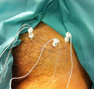 Placement of the needles in the sensory branches of the obturator and femoral nerves, together with intraarticular hip block.