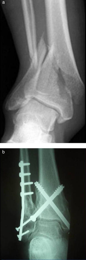 (a) Distal tibial fracture of AO type A3 and suprasyndesmotic fibular fracture. (b) Osteosynthesis of the tibial fracture with two AO 7.3mm screws and a one-third plate in the fibula (8 months after the intervention).