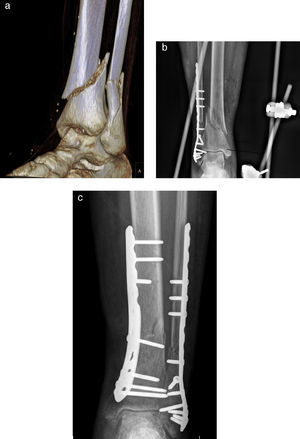 (a) 3D CT scan of the AO type A3 distal tibial fracture and transsyndesmotic fibular fracture. (b) Synthesis of transsyndesmotic fibular fracture with a PERI-LOC VLP plate (Smith and Nephew®) and Hoffmann II external fixator (Stryker®) with emergency bridging of the ankle. (c) Definitive synthesis of the tibial fracture with a locking compression plate (LCP Synthes®) (3 months after the intervention).
