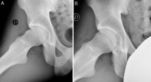 (A) Lateral hip projection (Dunn) with Cam-type lesion in a 26-year-old male. (B) Lateral hip projection (Dunn) with postoperative result following femoral osteoplasty.