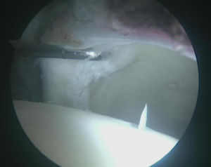 Arthroscopic view from the distal anterior portal. Labral lesion at the chondrolabral level.