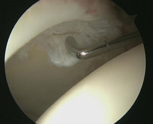 Arthroscopic view from the anterolateral portal. Flap-type lesion of the acetabular cartilage.