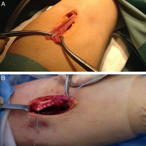 (A) Location of the distal tendon of the brachial biceps. (B) Passage of sutures through both portions of the tendon.