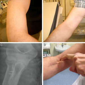 (A and B) Elevation of the muscle mass of the biceps secondary to rupture of the distal tendon. (C) Postoperative simple radiograph showing two bone anchors at the level of the bicipital tuberosity. (D) Image from the same patient 2 years after the reinsertion.