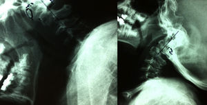 Dynamic radiographs in flexion and extension, showing superior cervical instability.
