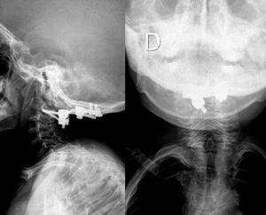 Postoperative radiographs after 6 years of follow-up.