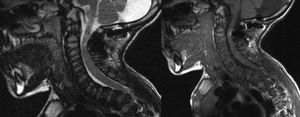 Postoperative MRI scan showing an increase of the spinal canal after spinal decompression.