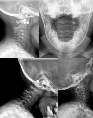 Static and dynamic radiographs illustrating how occipitocervical instability goes undetected in static images.