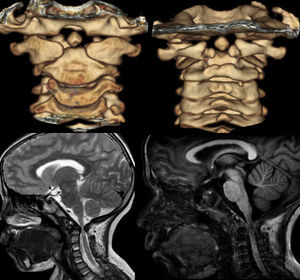 3D-CT reconstruction and MRI. Identification of C1 fusion anomalies, presence of os odontoideum and spinal compression at the occipitocervical level.