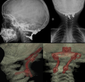 Postoperative radiographs after 1 year and 3D-CT reconstruction of the occipitocervical instrumentation.