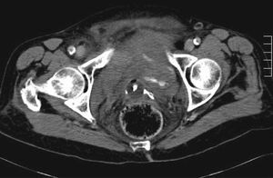 Abdominal CT image showing the hematoma.