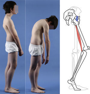 A 16-year-old male with high-grade spondylolisthesis. Schematic of pelvic retroversion compensated by hip extension (limited by the iliofemoral ligament), knee flexion and walking on tiptoe. Hamstring shortening makes thorax inclination difficult.