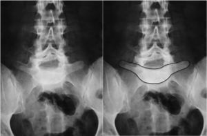 Image of the “inverted Napoleon hat sign” formed by the superposition of the dislocated body of L5 and the sacrum.