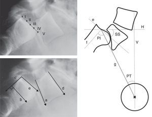 Radiographic measurements. Above, level of Meyerding sliding. Below, reference lines to measure the lumbosacral angle according to Boxall (a, b), Dubousset (c, d) and Wiltse (a, e). On the right, pelvic incidence (PI), pelvic rotation or tilt (PT) and sacral slope (SS). (a) Inferior plate of L5; (b) perpendicular line to c; (c) posterior edge of the sacrum; (d) superior plate of L5; (e) superior plate of the sacrum; (f) perpendicular to e; (g) line joining the center of e with the center of the femoral head (or half the distance between the center of both femoral heads); H: horizontal; V: vertical.