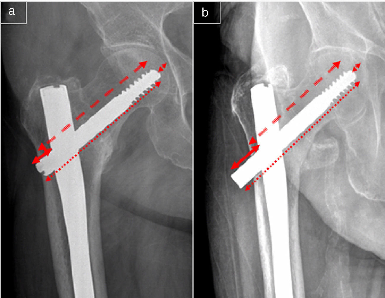 Randomized prospective study on the influence distal block and Gamma 3 nail  on the treatment of intertrochanteric fractures of femur | Revista Española  de Cirugía Ortopédica y Traumatología (English Edition)