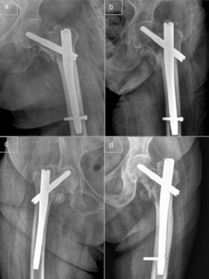 (a) and (b) Migration of the cephalic screw and varus collapse of the fracture following full dynamization of the Gamma nail. (c) Cut-out phenomenon. (d) Error in the placement of the blocking screw.
