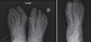 Double osteotomy with correction of the DMAA (PASA) and base osteotomy fixed with a Kirschner wire (left) and 1 needle (right), in both cases associated to Weil type osteotomies of the lesser metatarsals.