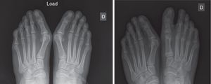 Comparative radiographs in a 20-year-old patient who was intervened through the technique described with excellent results.