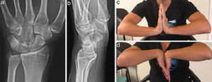 Simple AP and lateral radiograph (a and b), and in wrist flexion-extension (c and d) 1 year after the lesion.