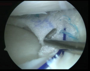 Arthroscopic view from the anterolateral portal of the polyurethane implant sutured to the medial meniscal tissue remaining in the right knee.