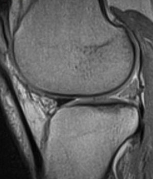 Sagittal T1-weighted spin-echo MRI at 1.5T after 1 year. The size of the implant in this case is the same as the normal meniscus (type 3). Signal intensity remains increased (type 1).