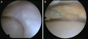 Arthroscopic view of the second exploration of the failed meniscal implant. (A) Complete union with the native meniscus in its anterior horn. (B) The posterior area of the implant shows fibrillation and rupture.
