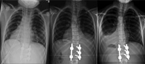Radiographic evolution of the thorax after the intervention: (a) immediate postoperative period, with pleural drainage, (b) at 10 days after the intervention, with the drainage removed and with minimal right reactive effusion, and (c) at 6 weeks, full resolution of the right reactive effusion and left pleural effusion with pulmonary collapse.