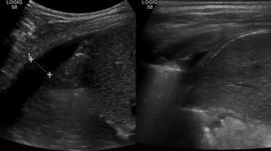 Evolution of chylothorax on ultrasound, (a) upon diagnosis and (b) 2 weeks after the treatment with thoracic drainage.