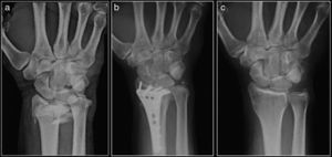 Radiograph with the wrist in anteroposterior projection. Type C3 distal radius fracture according to the AO classification. Type C3 distal radius fracture according to the AO classification synthesized with a volar LCP plate. Radiographic control 1 year after the surgery. Mirror image of the healthy contralateral wrist.
