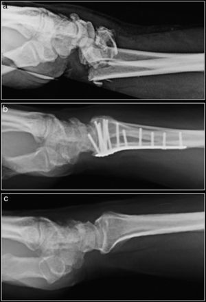 Radiograph with the wrist in lateral projection. Type C3 distal radius fracture according to the AO classification. Type C3 distal radius fracture according to the AO classification synthesized with a volar LCP plate. Radiographic control 1 year after the surgery. Mirror image of the healthy contralateral wrist.