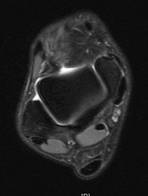 Axial T2 MRI image showing bone avulsion in the tibial malleolus.