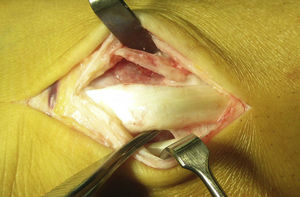 Avulsion fracture of the retinaculum, with release of the bone fragment in the flexor retinaculum.