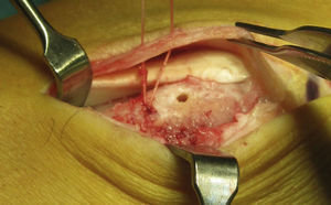 Reinsertion of the retinaculum with non-absorbable suture supported by 3mm titanium anchors.