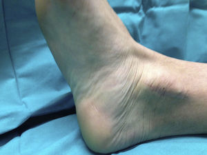 Image of the ankle in dorsal and inversion 2 years after the operation. The image shows the integrity of the flexor retinaculum.
