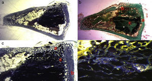 (a) Transverse cut. Masson's trichrome stain. Overall appearance of calcium phosphate+PRP: greater bone formation is observed in the site of the critical defect and between the particles of calcium cement. (b) Rabbit PRP group, 30 increases. Two-fold increase from the previous image. (a) Newly formed bone (immature) filling the defect. (b) Mature bone of the cortex. (c) Bone between the particles of the biomaterial. (c) Rabbit PRP group, 15 increases. Transverse cut. Masson's stain. General appearance: (a) cortex, (b) newly formed bone y (c) biomaterial. (d) Rabbit PRP group, 30 increases. Immature bone between the particles of calcium phosphate. The color of this figure can only be appreciated in the electronic version of the article.