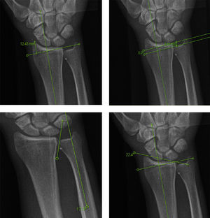 Measurement of radiological variables: radius height, ulnar variance, ulnar tilt and radial tilt (from top to bottom and left to right), in a patient with a middle-third carpal scaphoid fracture.