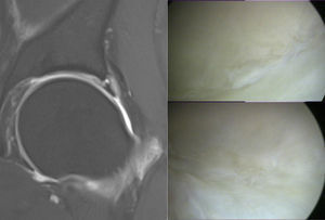 45 year old male. In the image on the left, in a coronal section, delamination of the acetabular cartilage and a sublabral cyst can be observed. The images on the right are intra-operative photos which show the chondral lesion seen on MR arthrography.