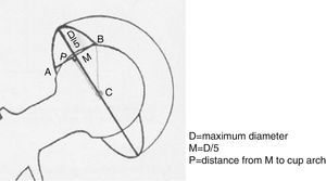 Measurement of the anteversion angle according to the Riten Pradhan method.