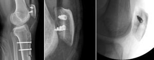 Patient from the autograft group reintervened to relocate a patellar anchor in the immediate postoperative period who evolved with no complications.