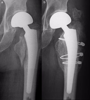 Case 6. (a) Type AL fracture, with radiographic monitoring; (b) postoperative radiographic monitoring 4 years after the reduction and fixation with 3 wire cerclages.