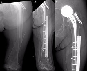 Case 11. (a) Type C fracture after isoelastic hemiarthroplasty; (b) postoperative radiographic monitoring 6 months afterwards, with fracture consolidation; (c) detailed view of the prosthesis, with signs of cotyloid infection. All the images show that the stem had been cemented when it was implanted, more than 20 years before the fracture.