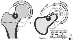 Drawings of the osteomas osteoids in our series. On the left, coronal view. On the right, axial view, with all the nidi projecting in the same cut (the numbers in the centre correspond to each case). The cortex and the reactive bone are shown in black, and the joint capsule in grey, with the joint cavity distended by the synovitis. The lower right section of the figure shows the radiofrequency device and the posterior approach to Case 4. The other cases were approached anteriorly, with more or less external limb rotation to make the nidus more accessible (curved arrow).