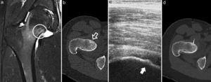 Case 5. (a) MRI in T2-weighted sequence of the proximal femur, with joint synovitis and osseous oedema, in whose bone core the nidus can be seen (circle); (b) CT axial cut, with the nidus in the anterior cortex of the femoral neck and slight endosteal bone formation (white arrow); (c) ultrasound monitoring during thermal ablation, with visualisation of the nidus in the bony cortex (dark arrow); (d) axial CT monitoring of the electrode located in the centre of the nidus.